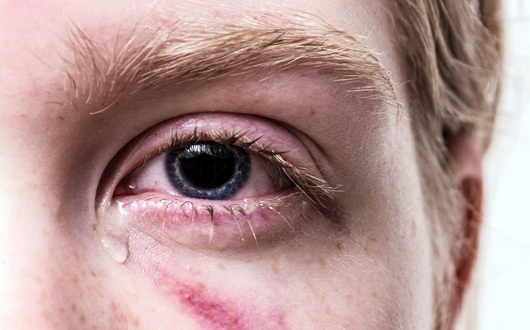 What Are Orbital Fractures? Surgery